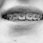 how much are braces in south africa