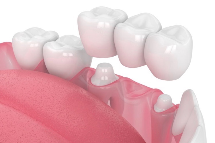 crowns for your teeth