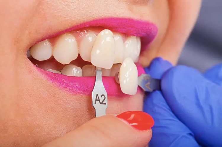 porcelain veneers being fitted