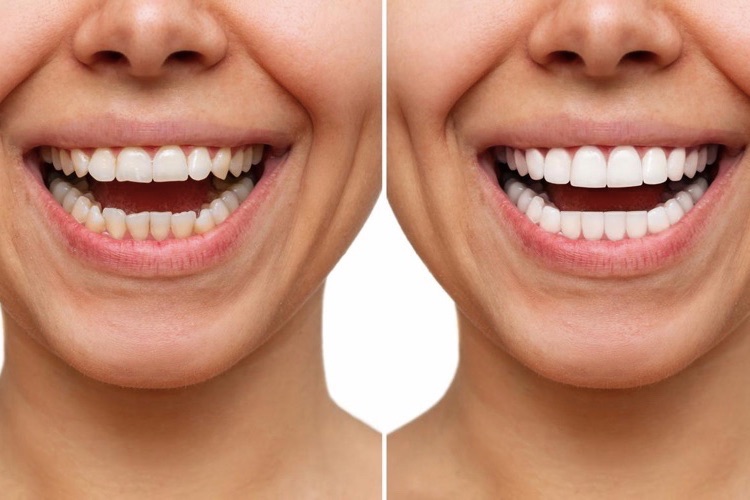veneers before and after