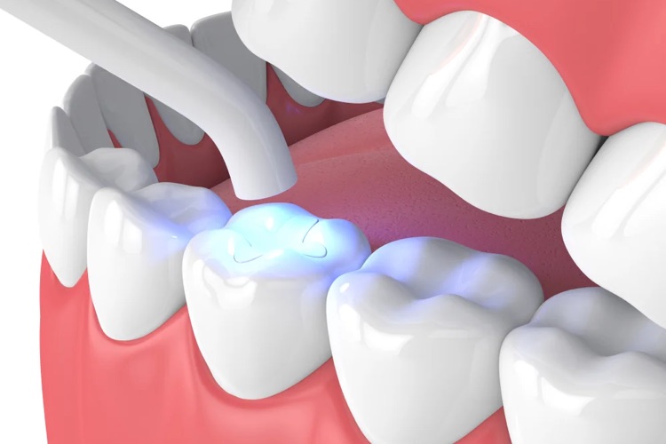 How Long Do Tooth Fillings Last?