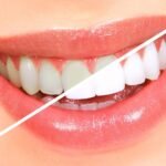 How long does teeth whitening last