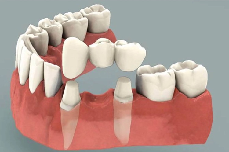 how long do dental bridges last