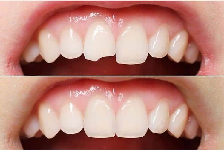 how long does dental bonding last?