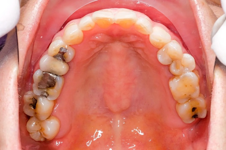 how many fillings can you get on the same tooth