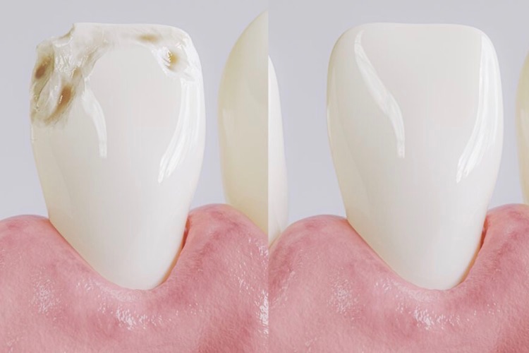 how to whiten tooth fillings