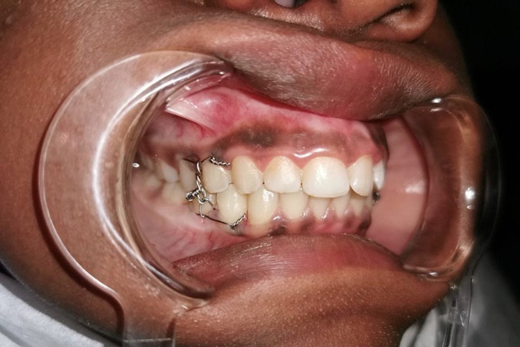 weight loss jaw wiring setup