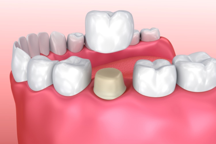 what cement is used for dental bridges
