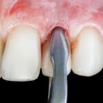 when can i start rinsing with salt water after tooth extraction