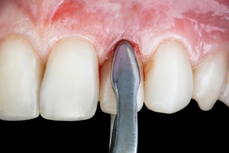 when can i start rinsing with salt water after tooth extraction