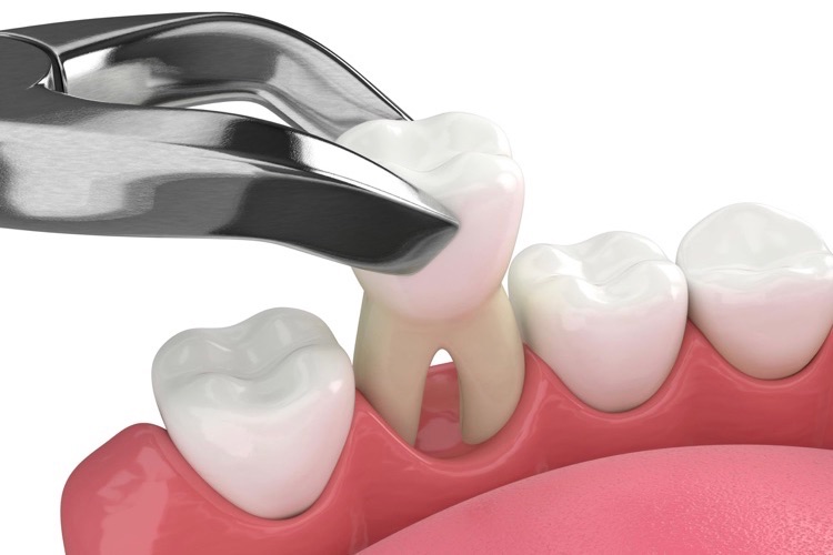 tooth extraction example